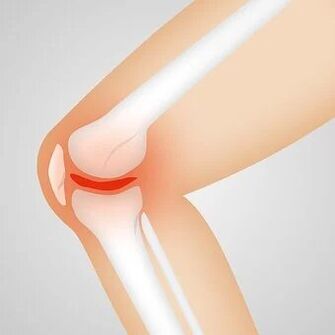 Osteoarthritis is a non-inflammatory pathology of the joint