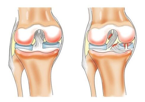 Healthy knee and knee joint arthrosis