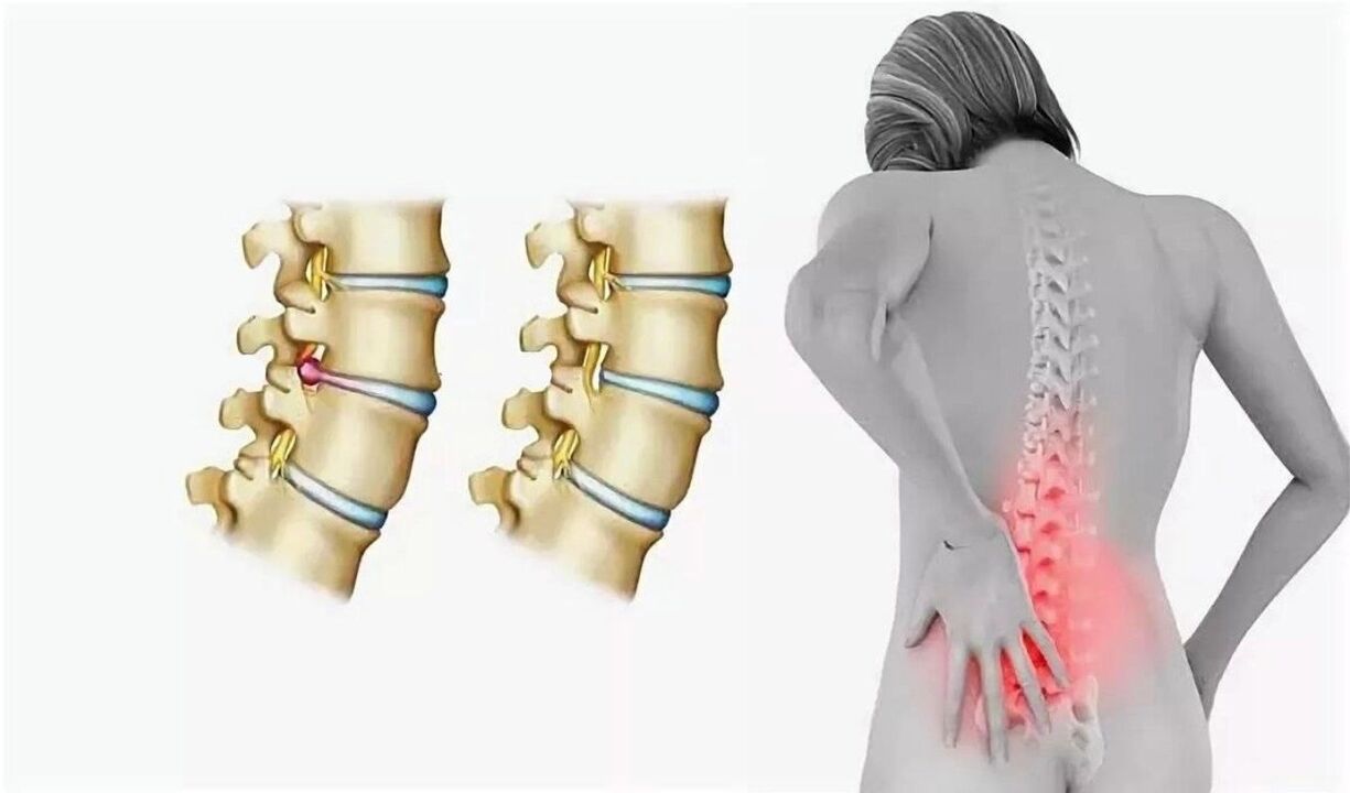 The danger of osteochondrosis of the spine